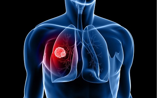 Nguyên nhân ung thư phổi do đâu?