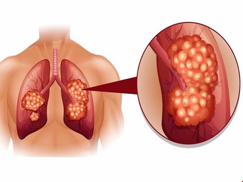 Triệu chứng và cách chữa ung thư phổi như thế nào?
