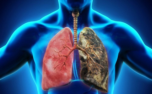  Ung thư phổi là gì?