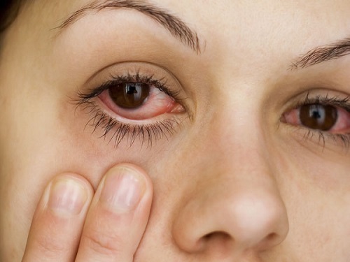 Nguyên nhân gây bệnh khô mắt là gì?