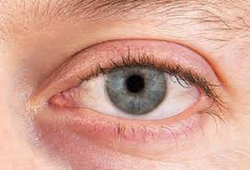 Bệnh khô mắt là gì?