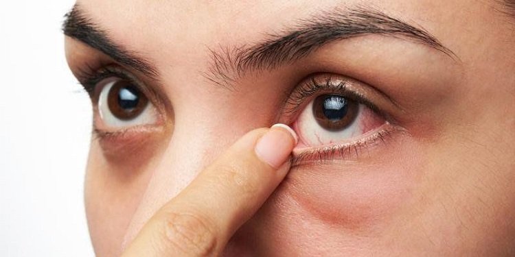 Vệ sinh kém là nguyên nhân gây đau mắt hột