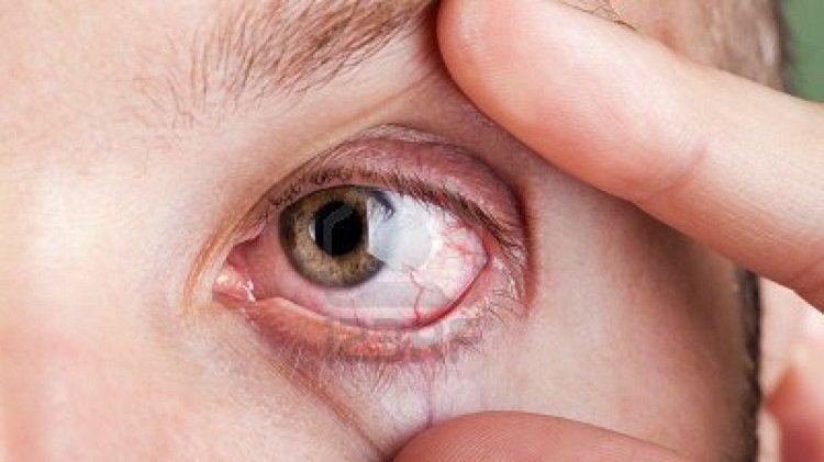 Đau mắt hột có nguy hiểm không? 
