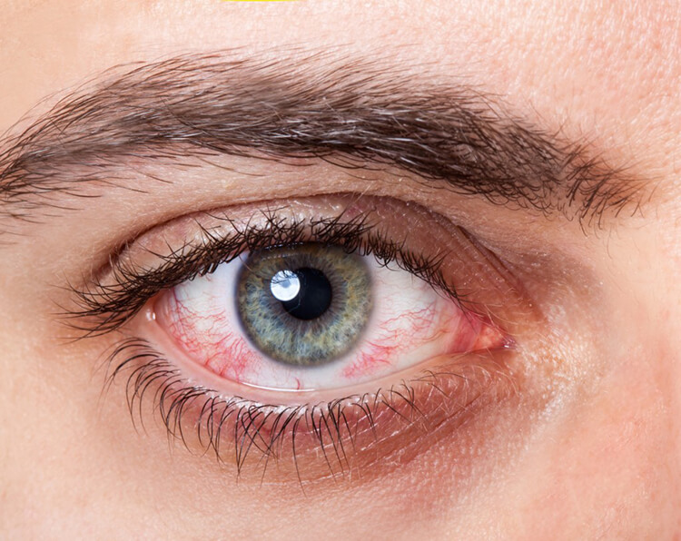 Thiếu vitamin A gây khô mắt